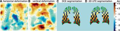 Echo time-dependent observed T1 and quantitative perfusion in chronic obstructive pulmonary disease using magnetic resonance imaging